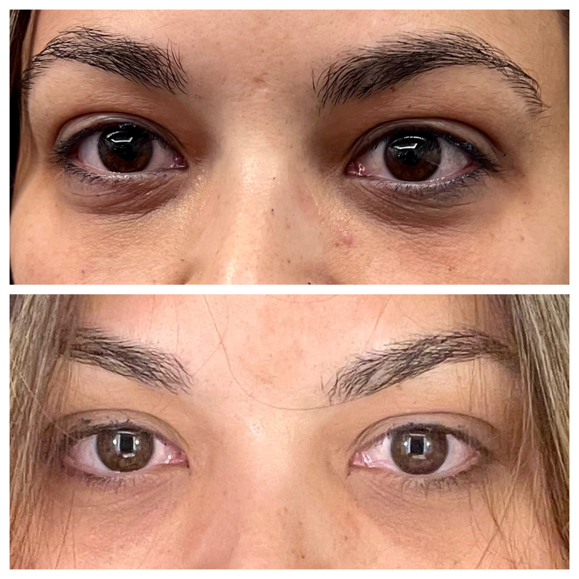 NeoGen Plasma- Eye Treatment before & after treatment photos in Leominster, MA | Opulent Aesthetics and Wellness