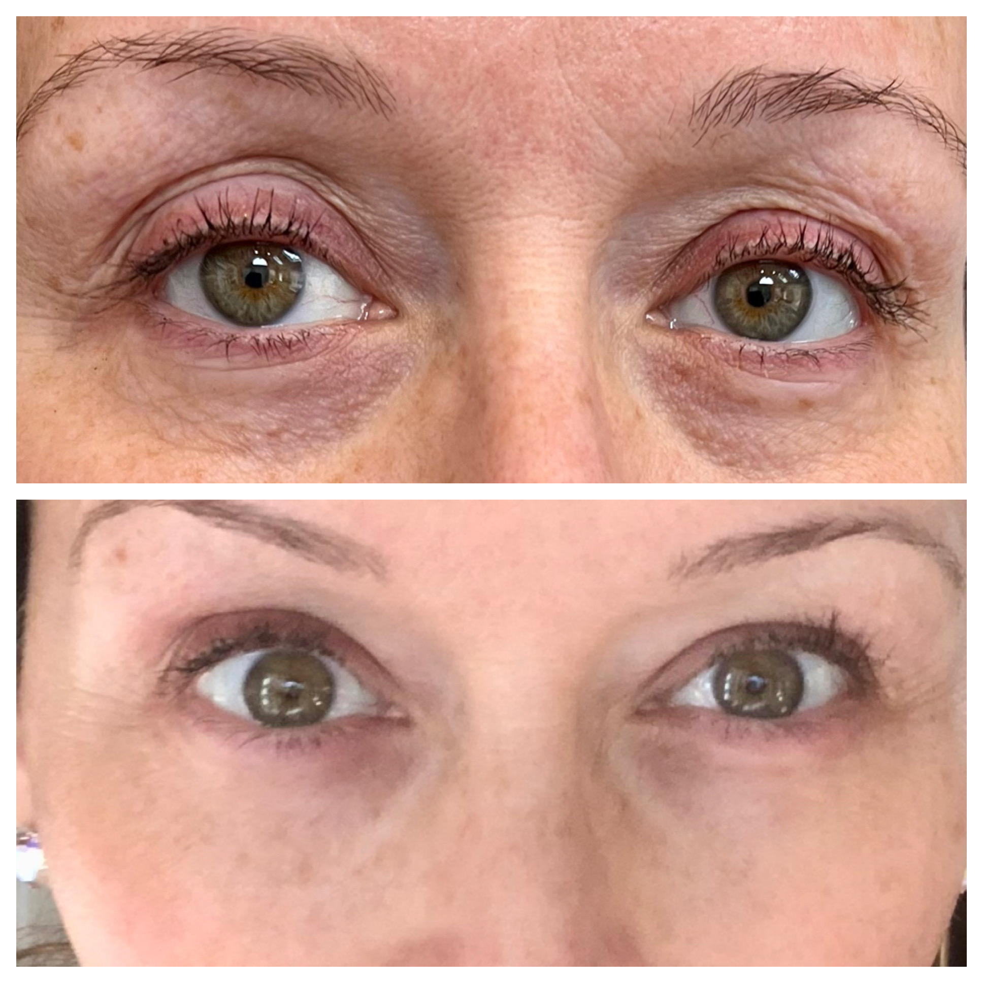 NeoGen Plasma- Non-Surgical Blepharoplasty before & after treatment photos in Leominster, MA | Opulent Aesthetics and Wellness