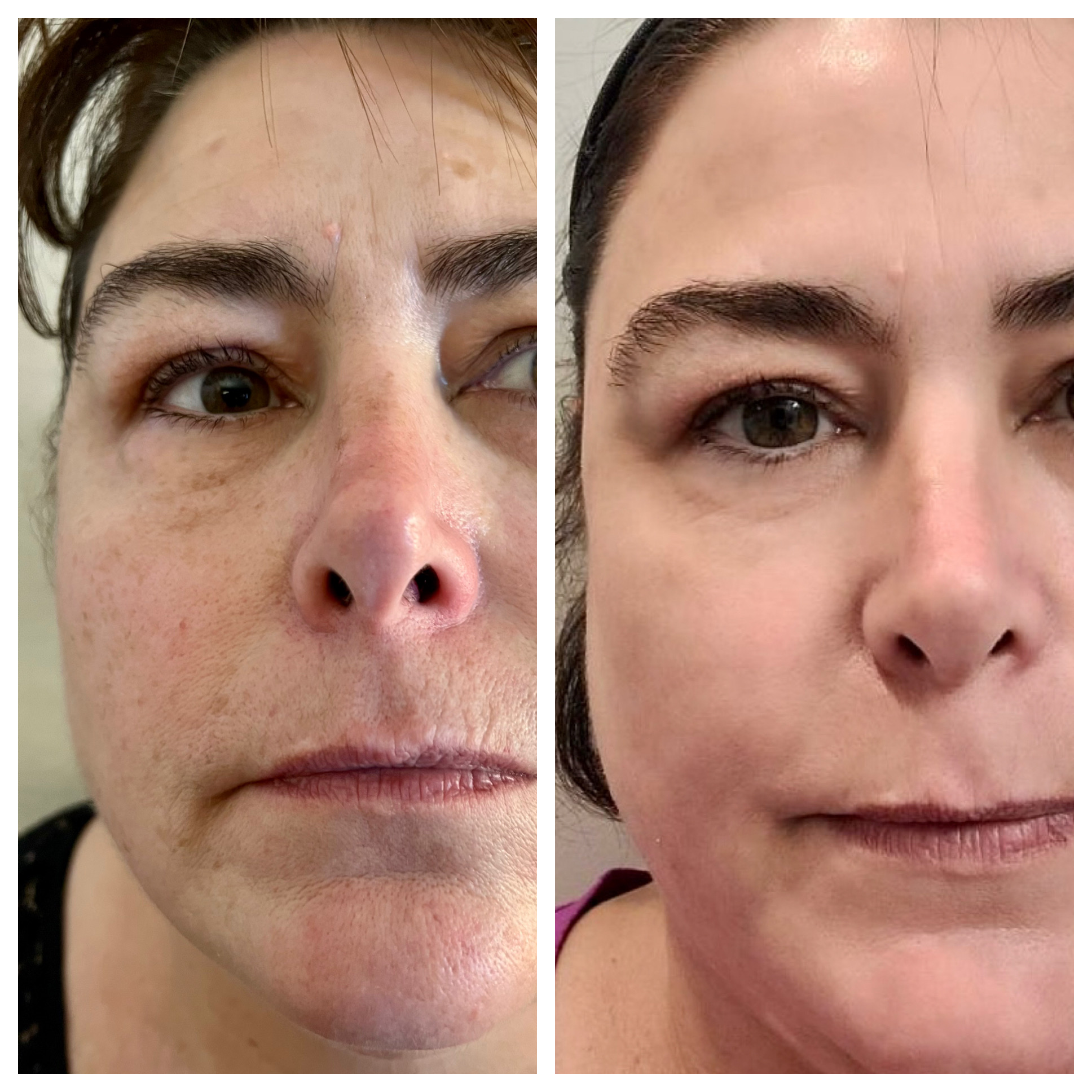 NeoGen Plasma-damagepigment reduction before & after treatment photos in Leominster, MA | Opulent Aesthetics and Wellness