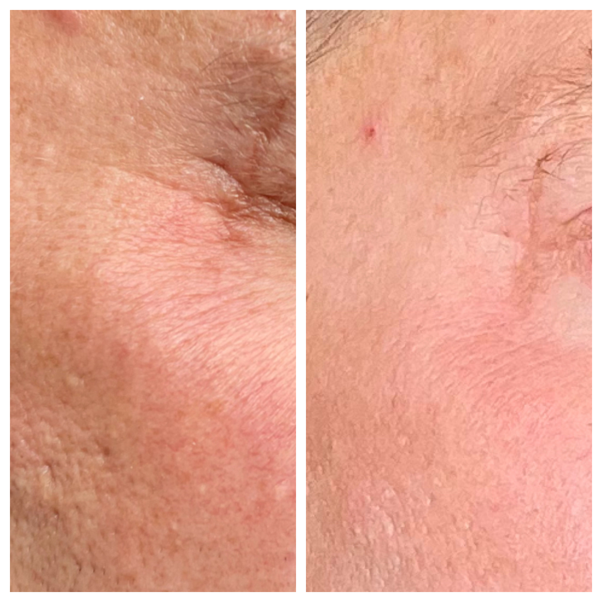NeoGen Plasma- Scar Revision before & after treatment photos in Leominster, MA | Opulent Aesthetics and Wellness