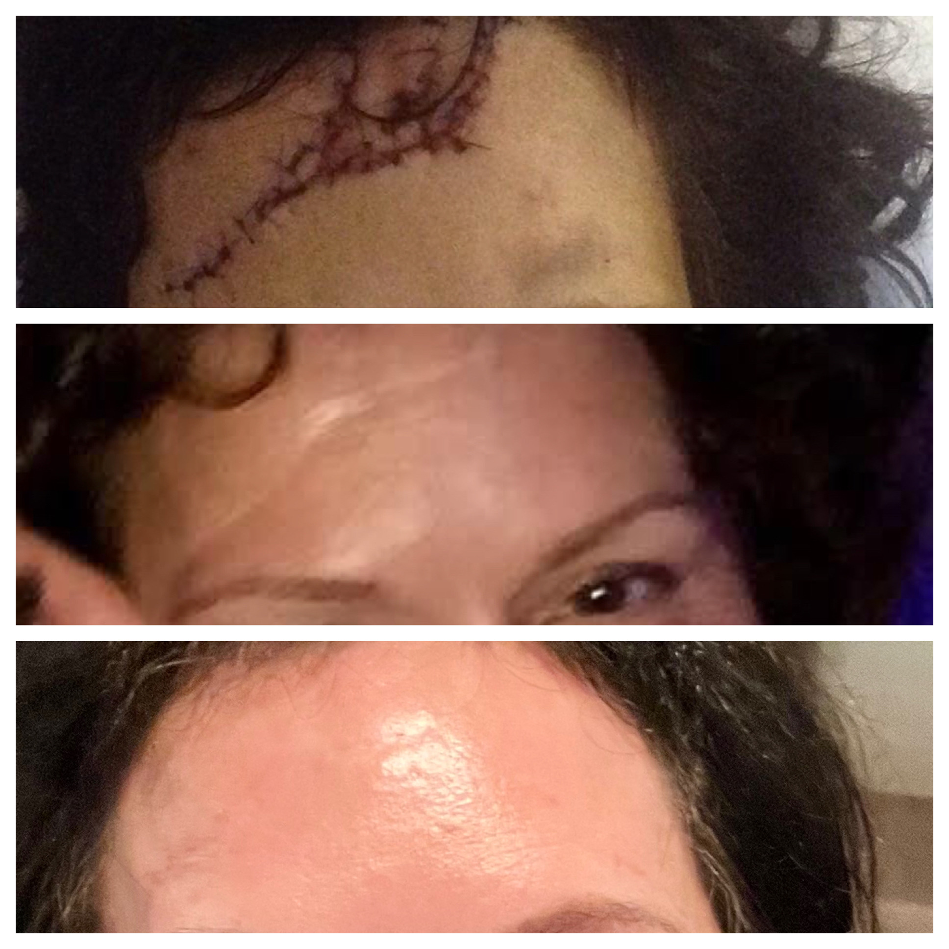 NeoGen Plasma- Scar Revision before & after treatment photos in Leominster, MA | Opulent Aesthetics and Wellness