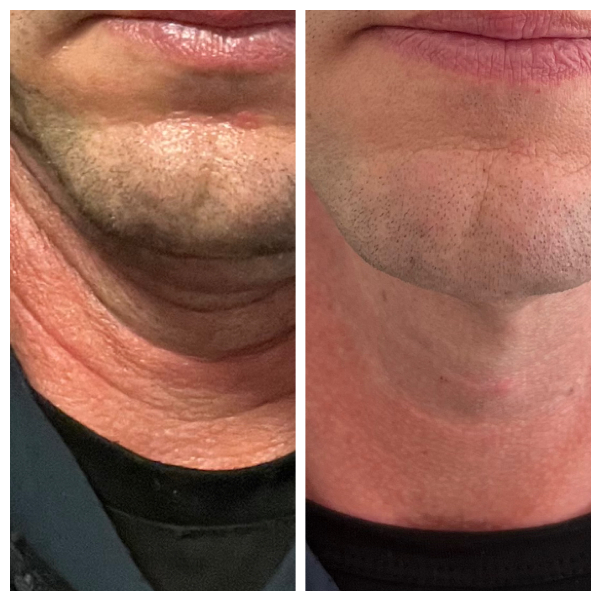 NeoGen Plasma-Skin Regeneration before & after treatment photos in Leominster, MA | Opulent Aesthetics and Wellness