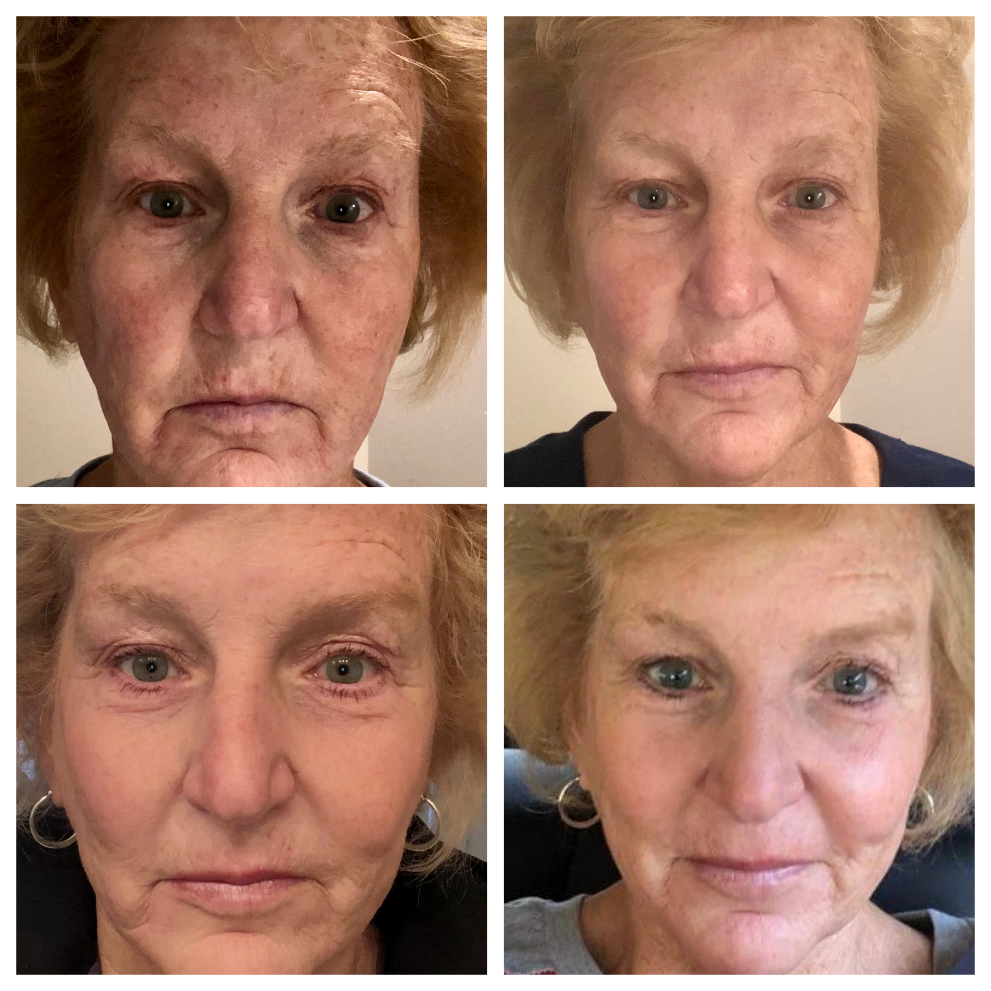 NeoGen Plasma Skin Regeneration before & after treatment photos in Leominster, MA | Opulent Aesthetics and Wellness
