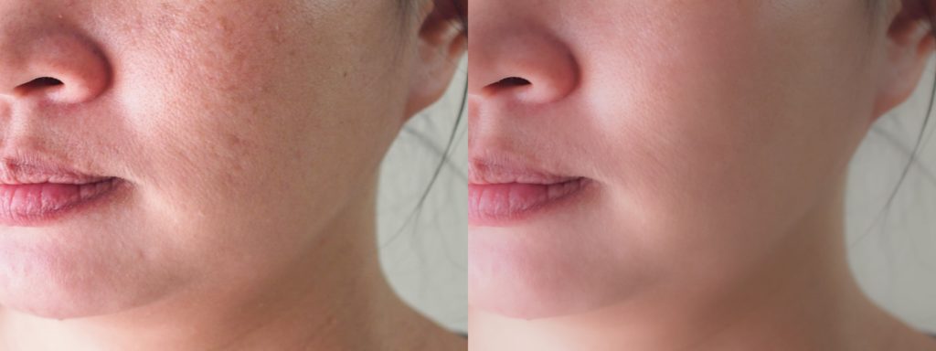 EMAGE Skin Analysis before & after treatment photos in Leominster, MA | Opulent Aesthetics and Wellness