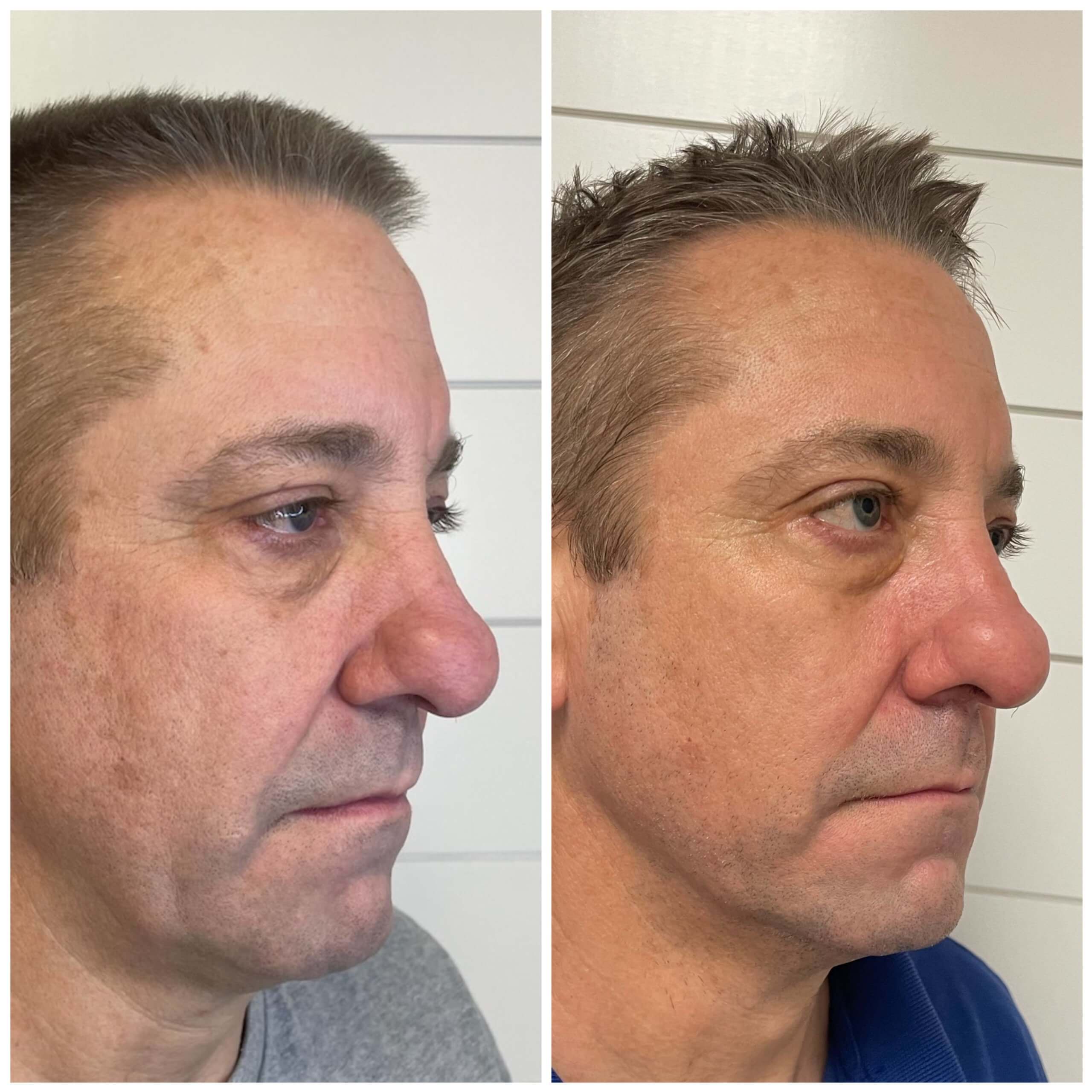 NeoGen Plasma-Skin Regeneration before & after treatment photos in Leominster, MA | Opulent Aesthetics and Wellness