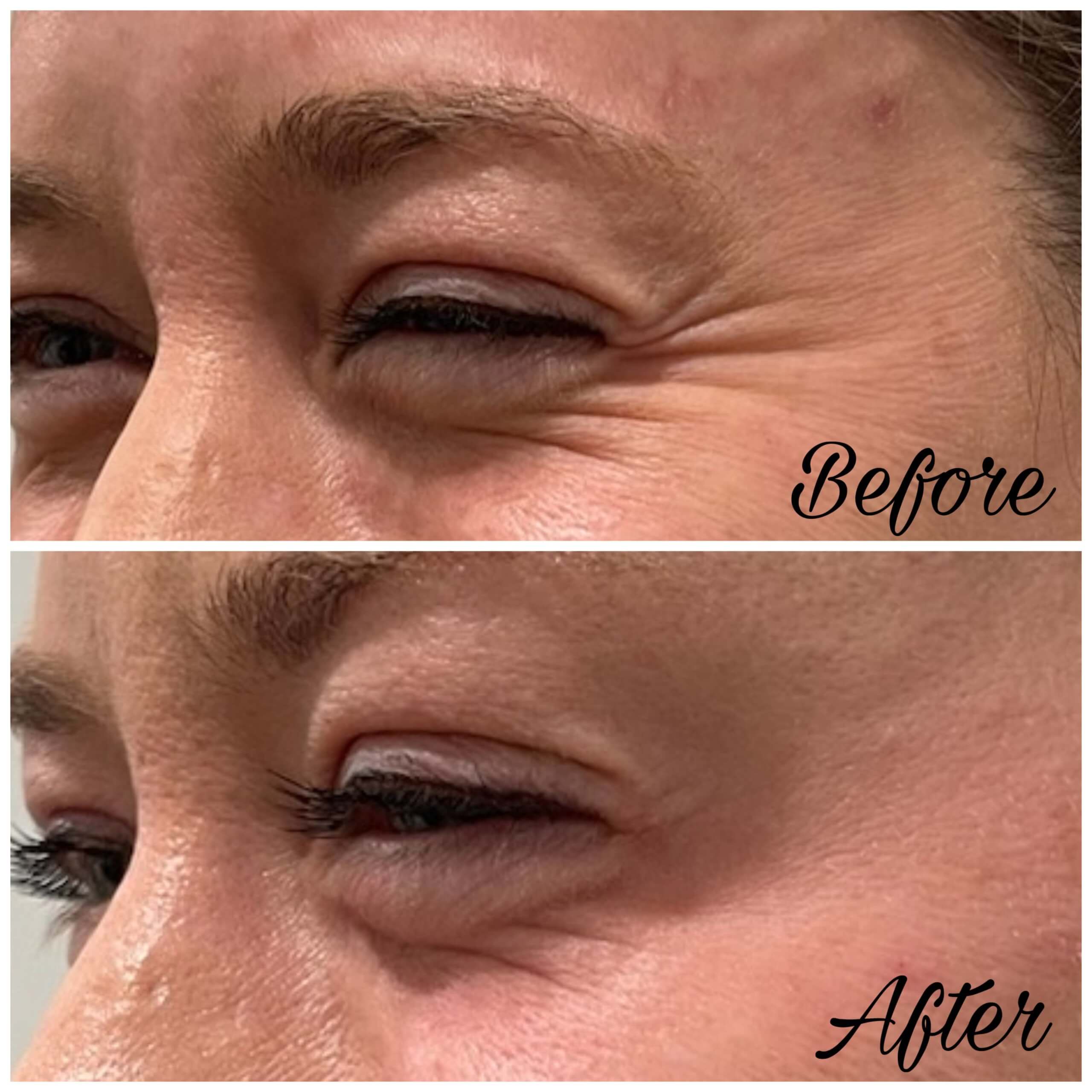 Botox before & after treatment photos in Leominster, MA | Opulent Aesthetics and Wellness